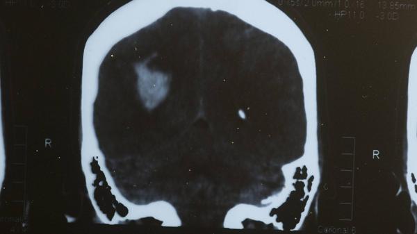 Koka Sus Passa A Oferecer Tratamento De Trombectomia Mecânica Para Pacientes Com Avc Isquêmico 2236